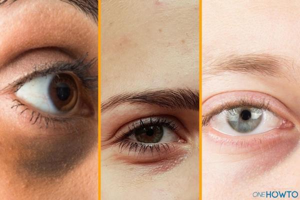6 tipos de ojeras debajo de los ojos