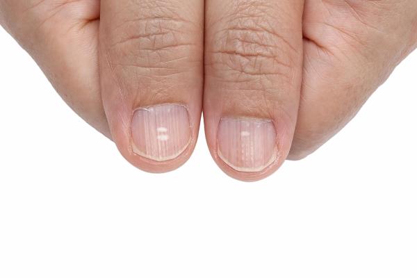 Cómo deshacerse de las manchas blancas en las uñas